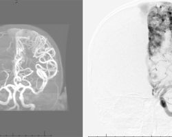 Left Arteriovenous Malformation (AVM) Left arteriovenous malformation (AVM) on MRA and cerebral angiogram
