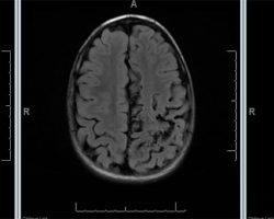 Left AVM Left arteriovenous malformation (AVM) on axial cut MRI