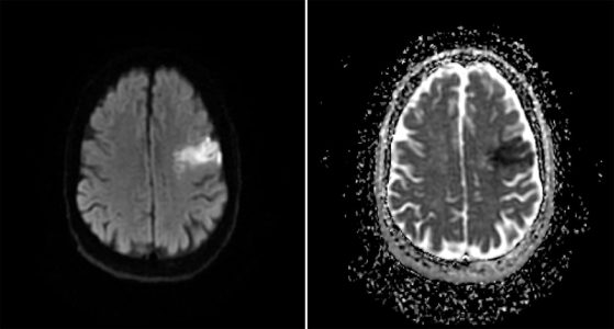 Acute Left MCA Infarct Acute Left MCA Infarct on MRI DWI and ADC