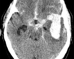 Left MCA Aneurysm Rupture Left MCA Aneurysm Rupture on CT head axial cut