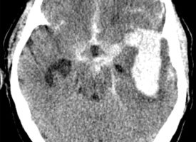 Left MCA Aneurysm Rupture Left MCA Aneurysm Rupture on CT head axial cut