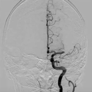 Left MCA Occlusion Left MCA Occlusion on cerebral angiogram