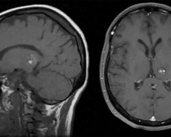 Left Thalamic Cavernous Malformation Left Thalamic Cavernous Malformation on MRI with classic "popcorn" appearance