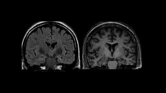Mesial temporal sclerosis Coronal MRI images showing left-sided mesial temporal sclerosis