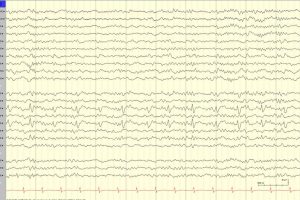 Left Lateralized Periodic Discharges (LPDs) EEG with lateralized periodic discharges (LPDs)