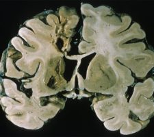 Remote ACA infarct Chronic/remote Left ACA Stroke seen on gross coronal cross section of brain