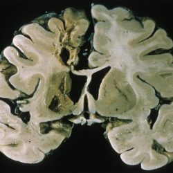 Remote ACA infarct Chronic/remote Left ACA Stroke seen on gross coronal cross section of brain