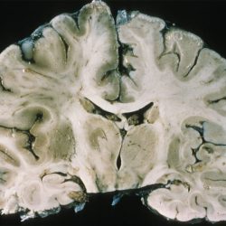 Acute Infarct with Focal Ischemia Left ICA Infarct on gross brain pathology coronal section