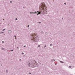 Lewy Body Lewy Body on pathology slide