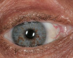 Hamartomas in the pigmented epithelium of the iris, consistent with Lisch nodules. BY Dimitrios Malamos, CC BY 4.0, via Wikimedia Commons https://commons.wikimedia.org/w/index.php?curid=45193921