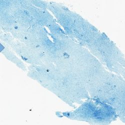 Chronic Multiple Sclerosis Plaque Chronic Multiple Sclerosis Plaque biopsy Luxol fast blue low power view showing decreased staining of a chronic demyelinated plaque