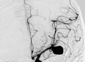 MCA Aneurysm MCA Aneurysm on cerebral angiogram