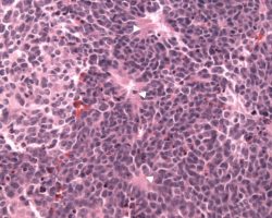 Medulloblastoma Medulloblastoma H&E stain with tightly packed neoplastic cells with tightly packed and round-to-ovoid or “carrot-shaped” nuclei. There is also high mitotic and/or apoptotic activity, show with neuroblastic rosettes (Homer Wright rosettes)