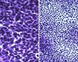 Medulloblastoma Medulloblastoma microscope Smear showing hypercellularity with small round blue cells and scant cytoplasm
