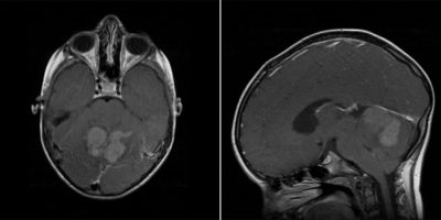 Medulloblastoma Medulloblastoma on axial and sagittal MRI with contrast