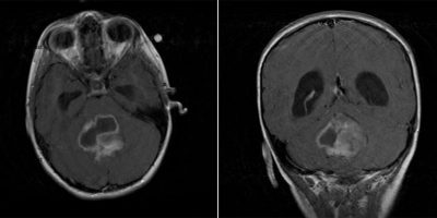 Medulloblastoma Medulloblastoma on axial and coronal MRI T2 FLAIR