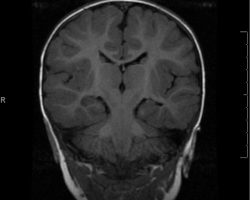 Mesial Temporal Sclerosis epilepsy patient with mesial temporal sclerosis on MRI