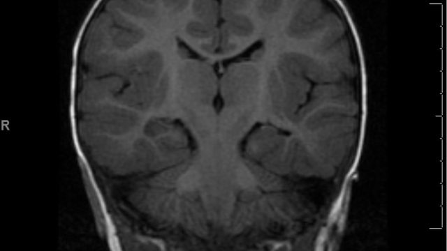 Mesial Temporal Sclerosis epilepsy patient with mesial temporal sclerosis on MRI