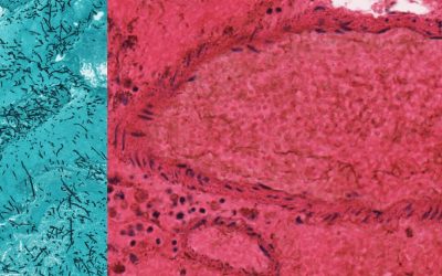 Aspergillosis Aspergillosis on silver stain and H&E stain microscope pathology slides
