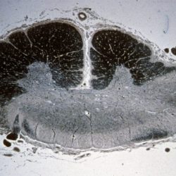 Asymmetric Thoracic Cord Demyelination Asymmetric Thoracic Cord Demyelination on a pathology slide of a patient with neuromyelitis optica
