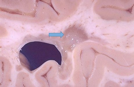 Multiple Sclerosis Plaque Multiple Sclerosis Plaque on gross brain specimen