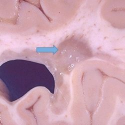 Multiple Sclerosis Plaque Multiple Sclerosis Plaque on gross brain specimen
