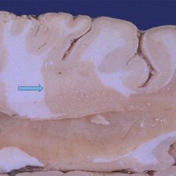 Multiple Sclerosis Plaque Multiple Sclerosis plaque on gross pathology section with Well-demarcated tan-gray patches of demyelination