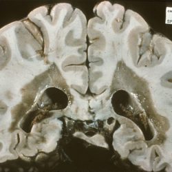 Multiple Sclerosis Plaque Multiple Sclerosis Plaques on gross pathology brain section of patient with multiple sclerosis