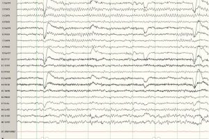 Mu Rhythm (left hemisphere) EEG tracing with mu rhythm in the left hemisphere on bipolar montage