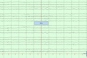 Mu Rhythm EEG tracing with mu rhythm on bipolar montage