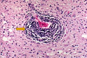 Multiple Sclerosis H&E stained brain biopsy showing inflammatory infiltration of the perivascular space consistent with multiple sclerosis