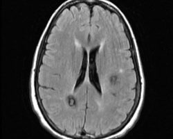 Multiple Cavernous Malformations Cavernous Malformations on MRI with popcorn appearance
