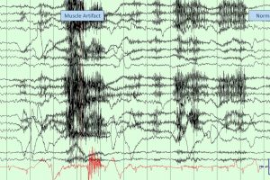 EMG artifact on EEG EMG artifact on EEG