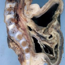 Myelomeningocele Gross pathologic specimen of Myelomeningocele