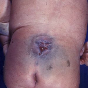 Lumbosacral Myelomeningocele Infant with Lumbosacral myelomeningocele