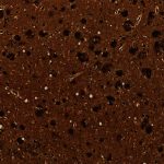 Neuritic Plaques Neuritic Plaques