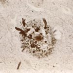 Neuritic Plaques Neuritic amyloid Plaques on silver stain slide