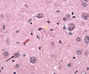 Alzheimer's Disease Alzheimer's Disease Neurofibrillary tangles on H&E stain