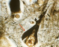 Alzheimer's Disease Alzheimer's Disease Neurofibrillary tangles on silver stain
