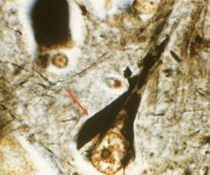 Alzheimer's Disease Alzheimer's Disease Neurofibrillary tangles on silver stain