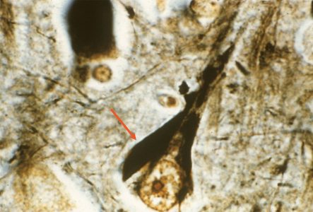 Alzheimer's Disease Alzheimer's Disease Neurofibrillary tangles on silver stain