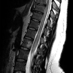 Lumbar Conus Medullaris Plaque in Neuromyelitis Optica Lumbar Conus Medullaris Plaque in Neuromyelitis Optica on Sagittal MRI spine