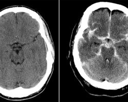 Subarachnoid Hemorrhage Subarachnoid Hemorrhage on CT head