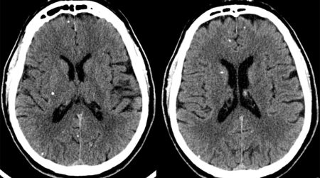Cysticercosis (old) Neuroinfectious disease: Cysticercosis on head CT