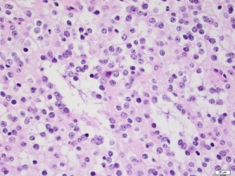 Oligodendroglioma Oligodendroglioma biopsy pathology slide with cells with the classic fried egg appearance