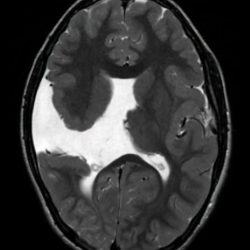 Schizencephaly Neurodiagnostic studies: Axial MRI, T2, showing open-lipped (Type 2) schizencephaly