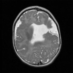 Schizencephaly Axial MRI showing open-lipped (Type 2) schizencephaly