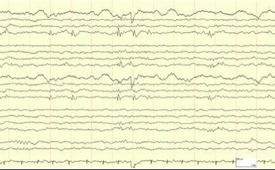 Panayiotopoulos Syndrome EEG of patient with Panayiotopoulos Syndrome showing Occipital sharp waves
