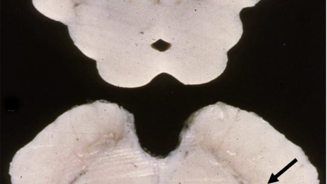 Parkinson's Disease Parkinsons Disease midbrain cross section with pale substantia nigra