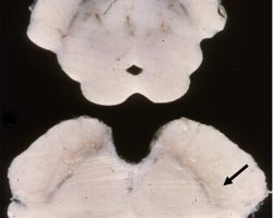 Parkinson's Disease Parkinsons Disease midbrain cross section with pale substantia nigra